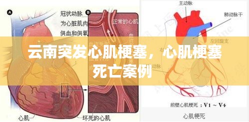 云南突發(fā)心肌梗塞，心肌梗塞死亡案例 