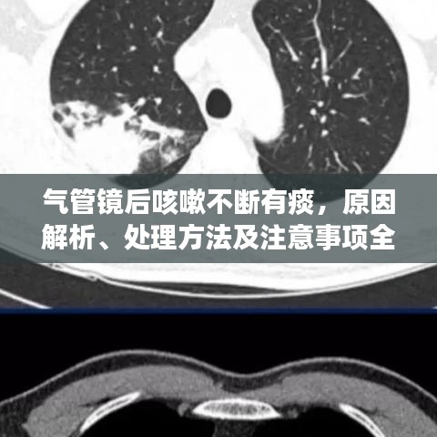 氣管鏡后咳嗽不斷有痰，原因解析、處理方法及注意事項(xiàng)全攻略