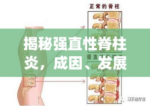 揭秘強(qiáng)直性脊柱炎，成因、發(fā)展與突發(fā)性的真相解析